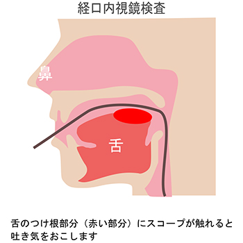 経鼻内視鏡のメリットイメージ
